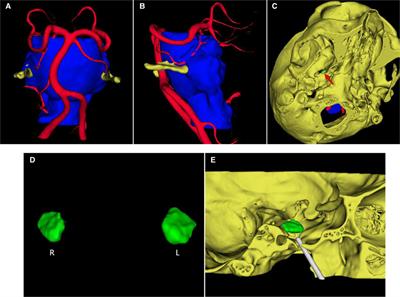 Combination of Preoperative Multimodal Image Fusion and Intraoperative Dyna CT in Percutaneous Balloon Compression of Trigeminal Ganglion for Primary Trigeminal Neuralgia: Experience in 24 Patients
